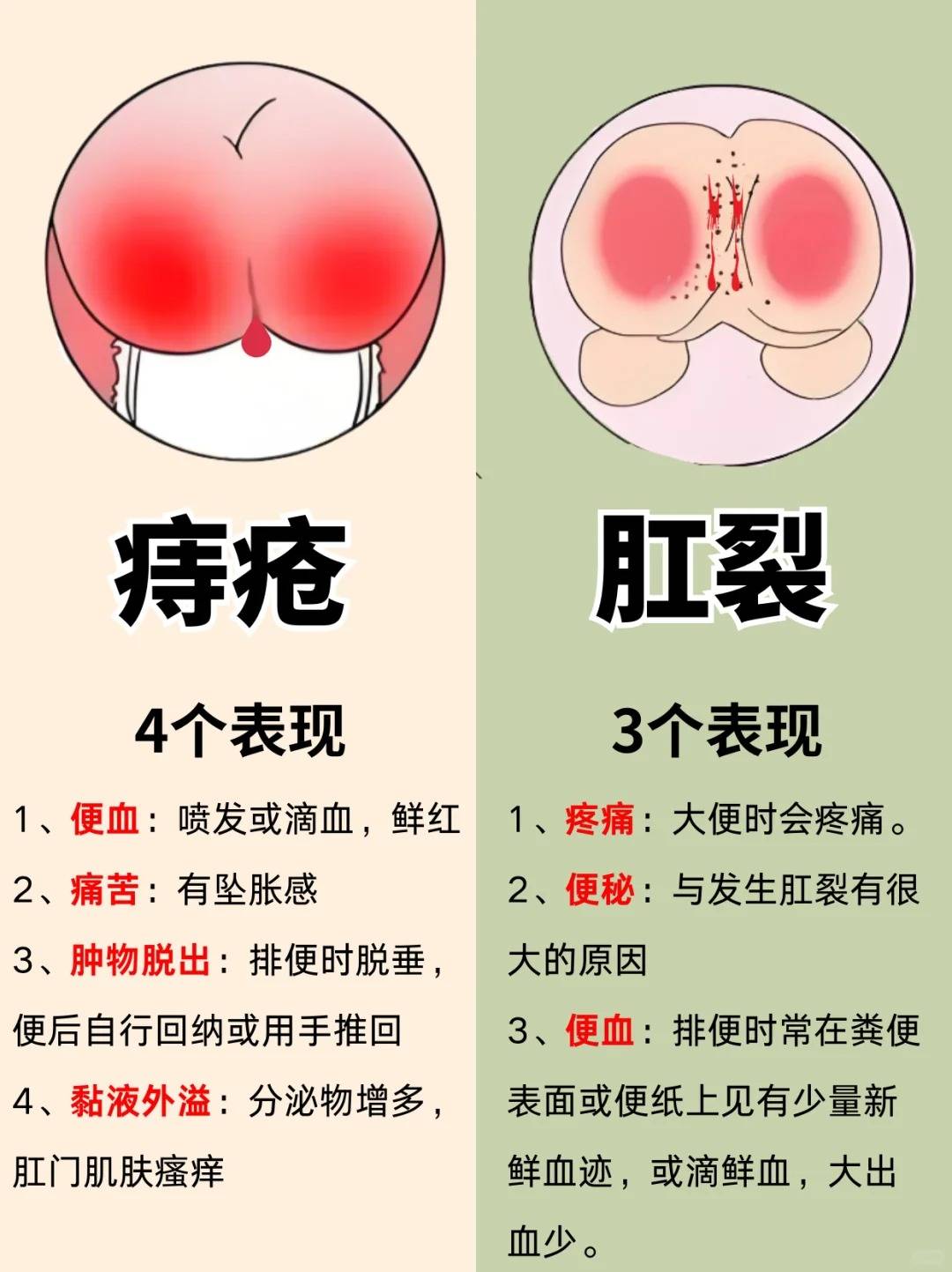 外痔疮怎么办