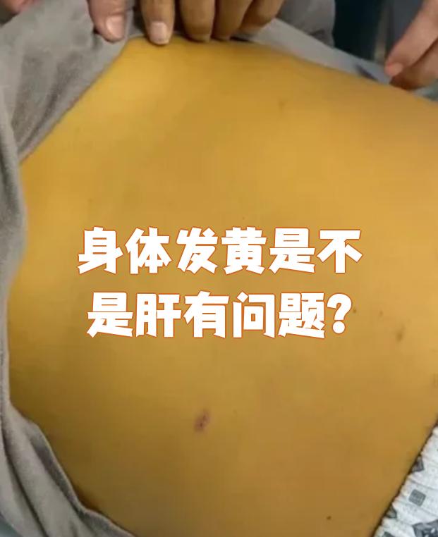 胆汁淤积性肝炎的表现是什么