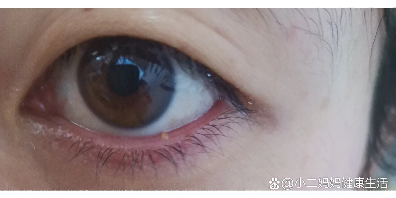 眼皮底下长了一个疙瘩