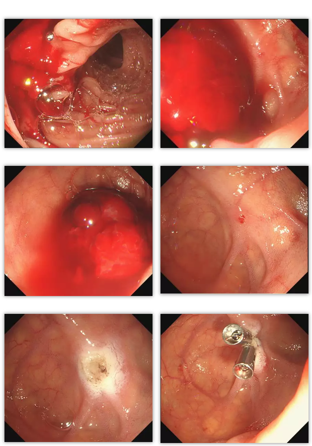 消化道出血几天能痊愈
