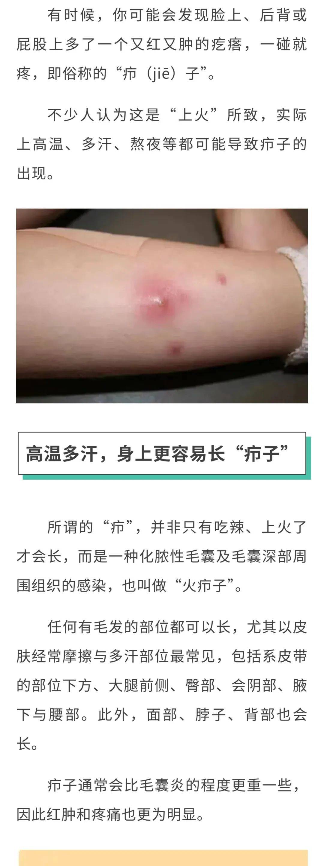 外阴上火长痘痘怎么办?