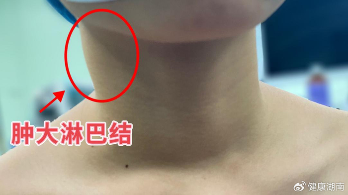 甲状腺癌的早期症状有哪些?