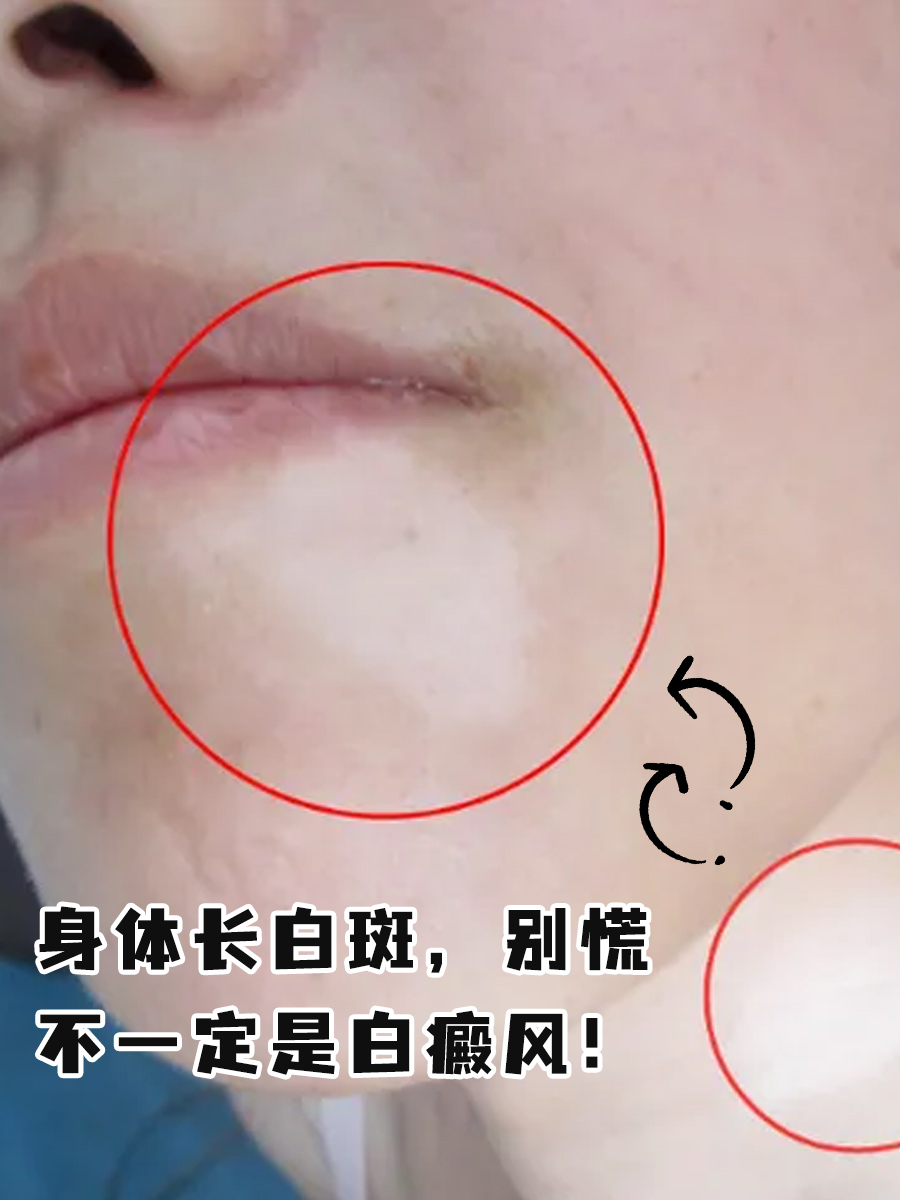 白斑病是怎么得来的?