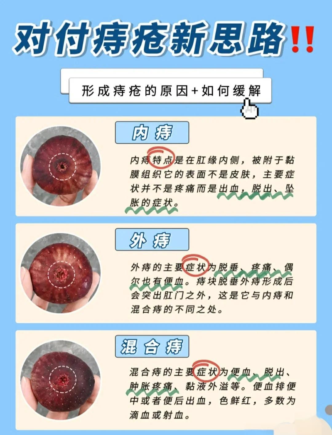 痔疮的最有效治疗方法