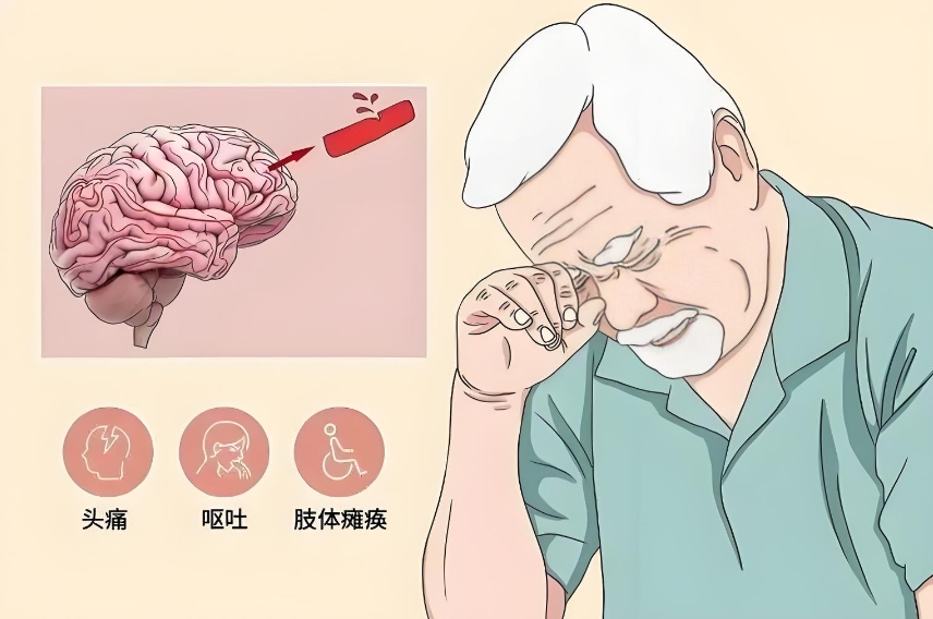 脑出血的症状表现