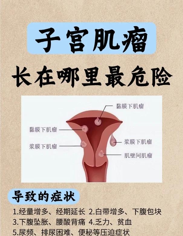 子宫肌瘤属于肿瘤吗