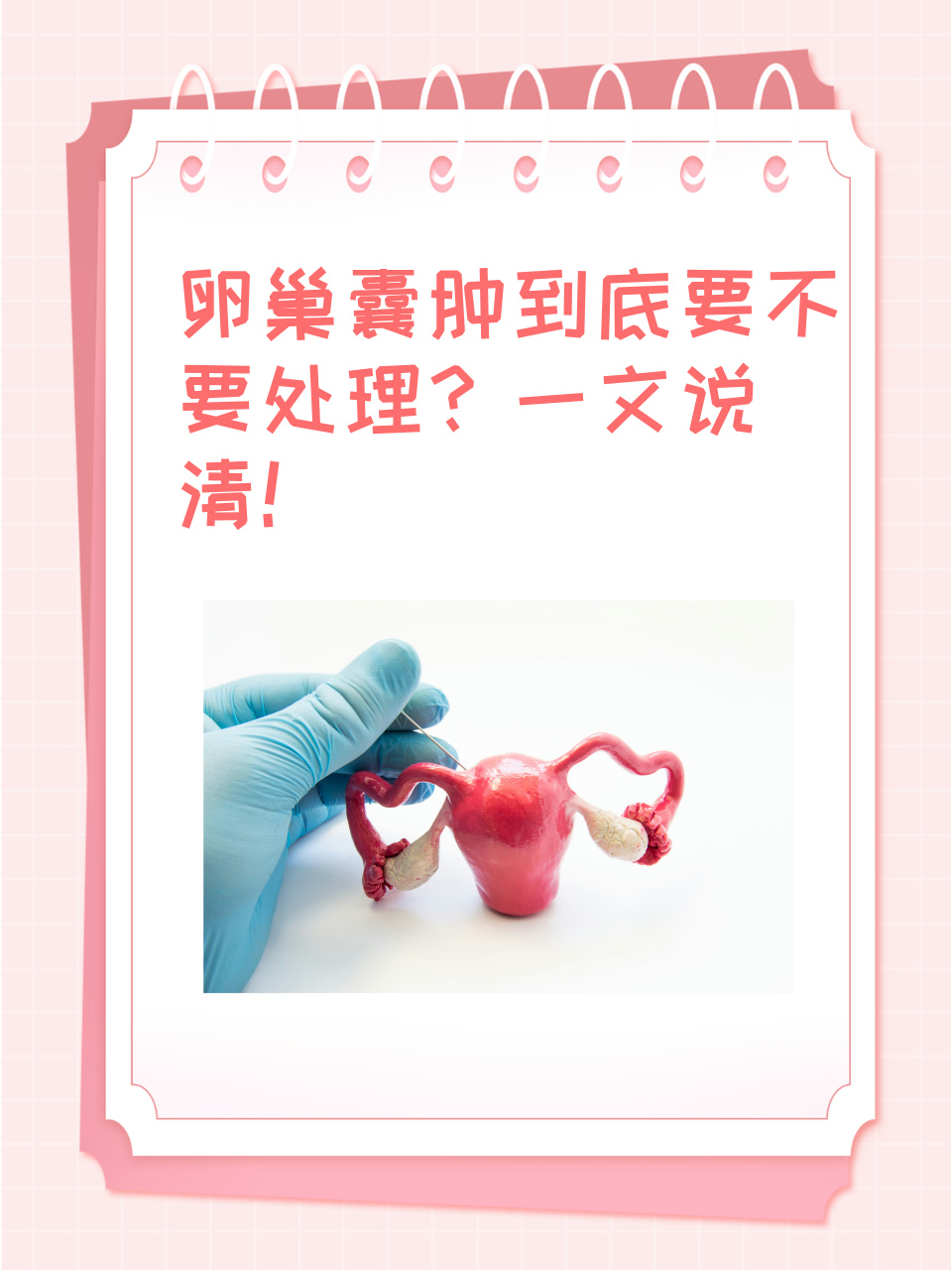 什么是附件囊肿?