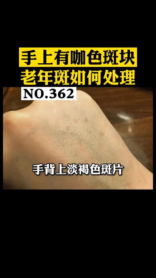 手上长斑是怎么回事