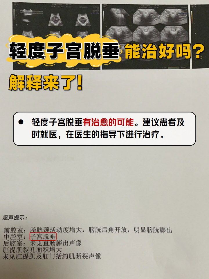 子宫脱垂怎么治疗比较好