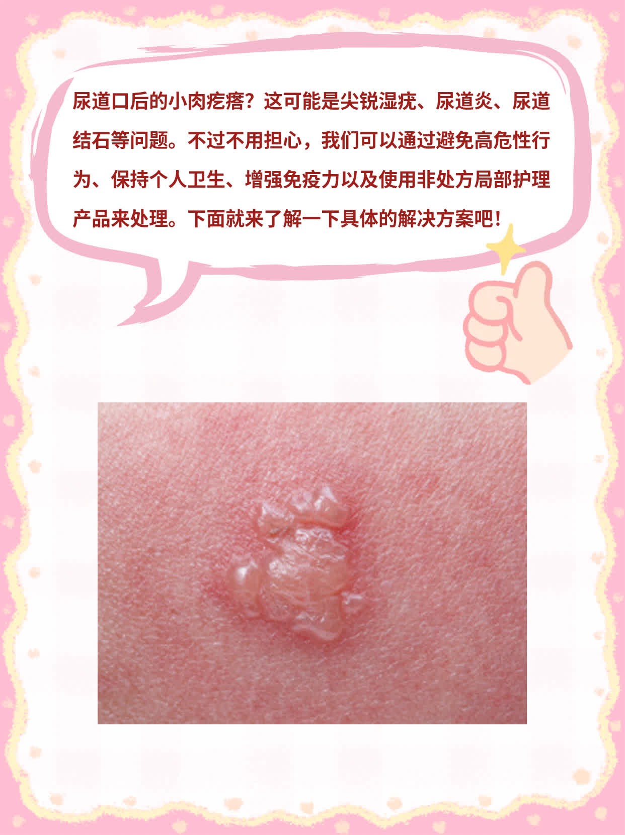 外阴长了肉疙瘩不疼不痒