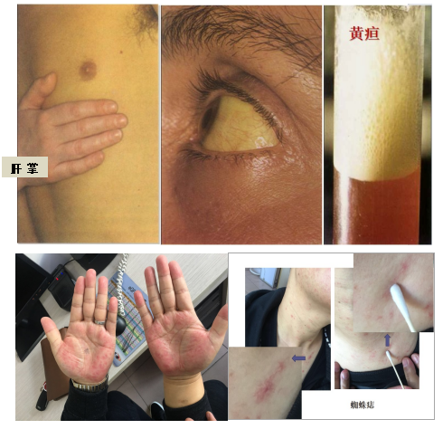 中度脂肪肝的症状有哪些