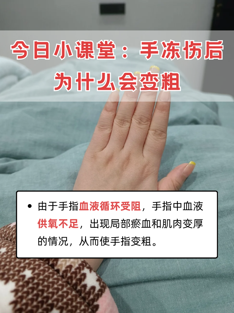 手指关节粗怎么能变细?