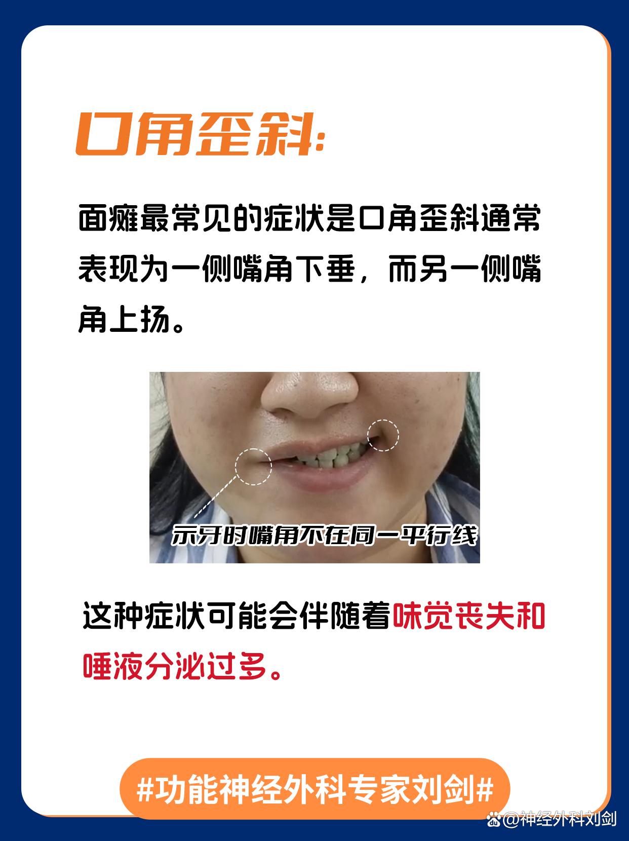 面瘫有什么前兆