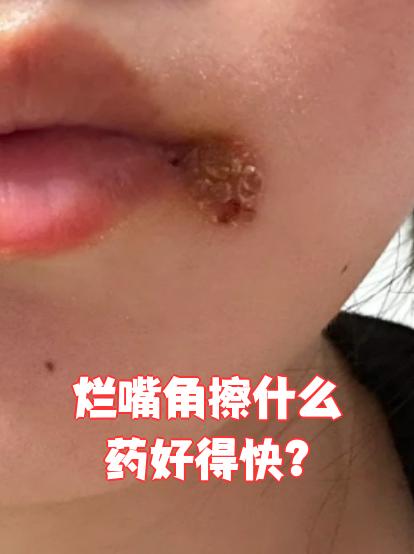 嘴角坏了怎么办