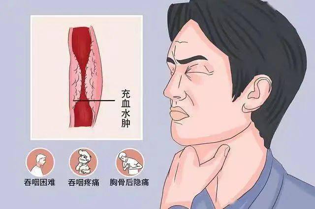 食道炎的早期症状表现是什么
