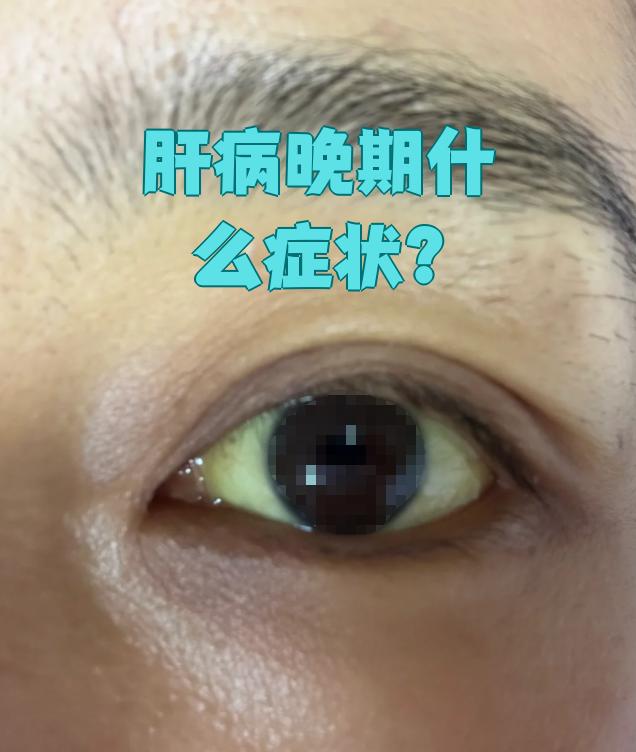 甲肝的症状表现有哪些?