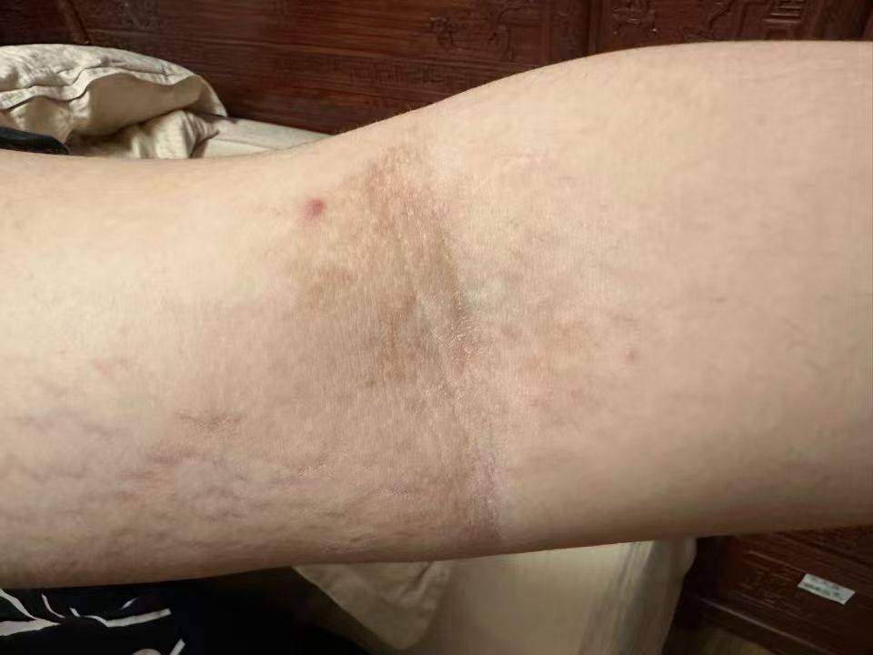 黑变病能治愈吗