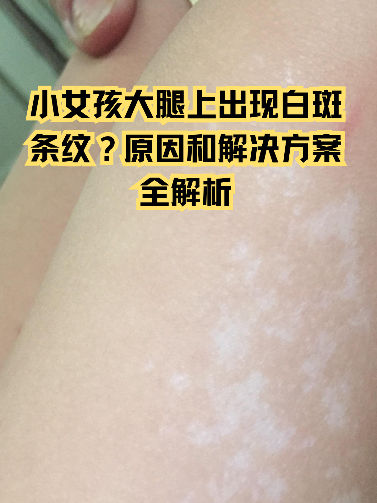白色肥胖纹可以消除吗