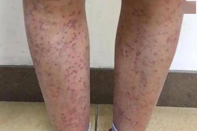 糖尿病并发症早期症状是什么