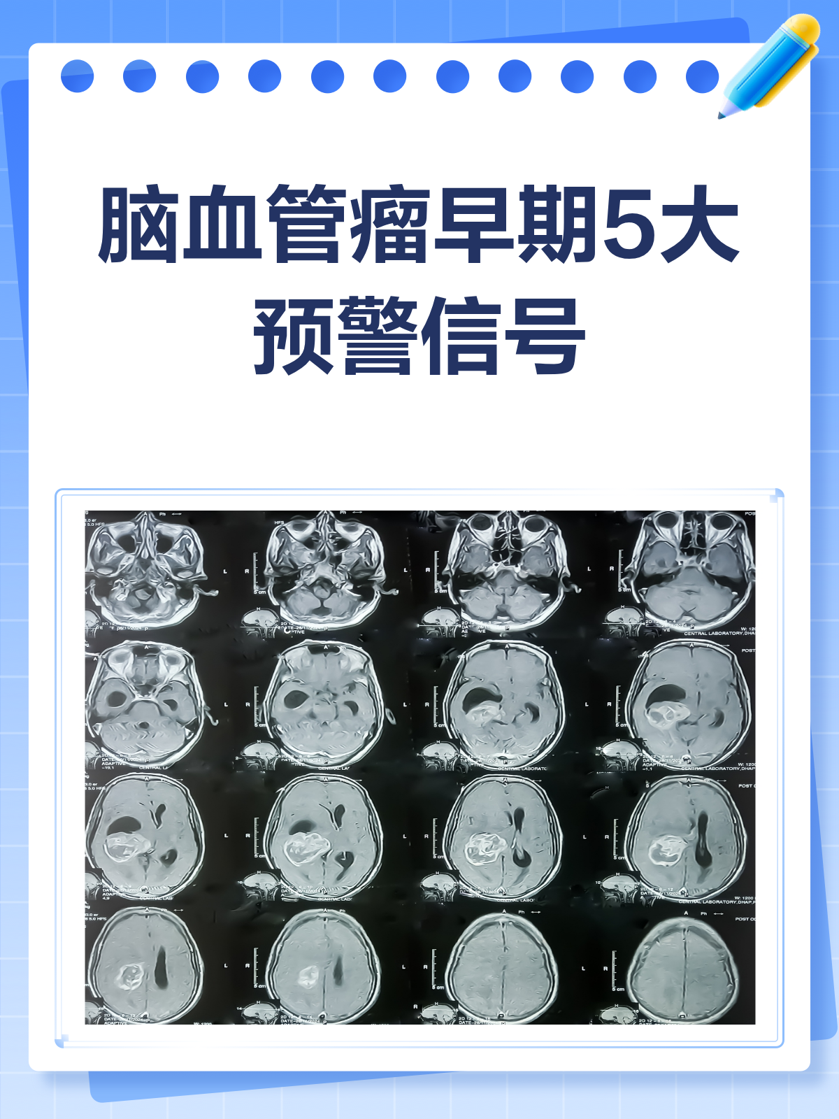 脑血管畸形的症状