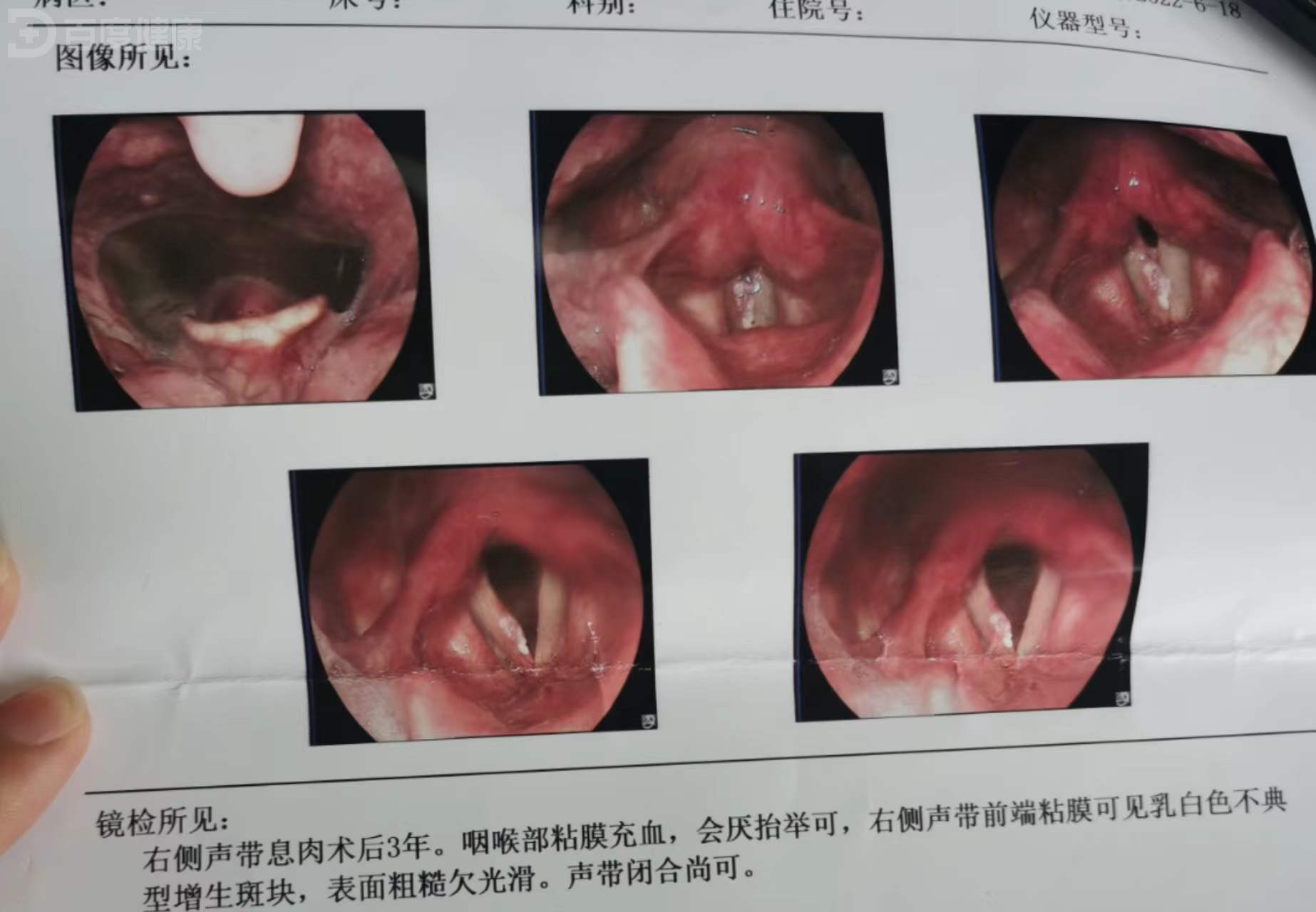 声带息肉不做手术行吗
