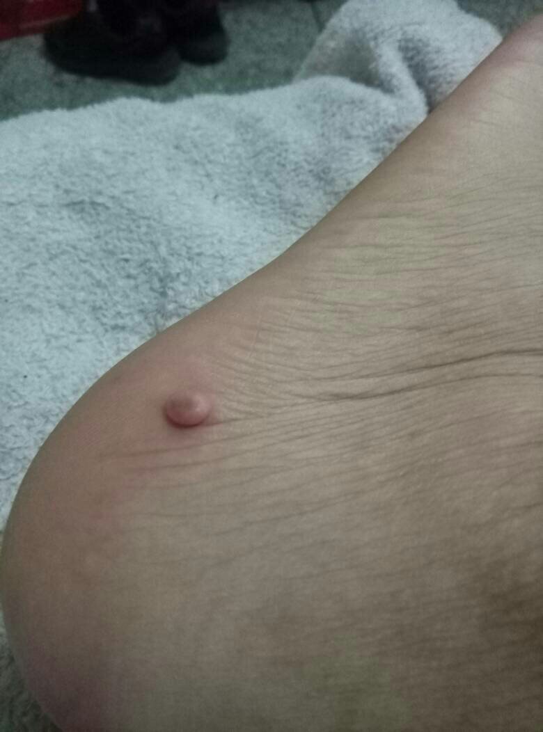 前两天拖鞋发现脚上长了个肉疙瘩如图