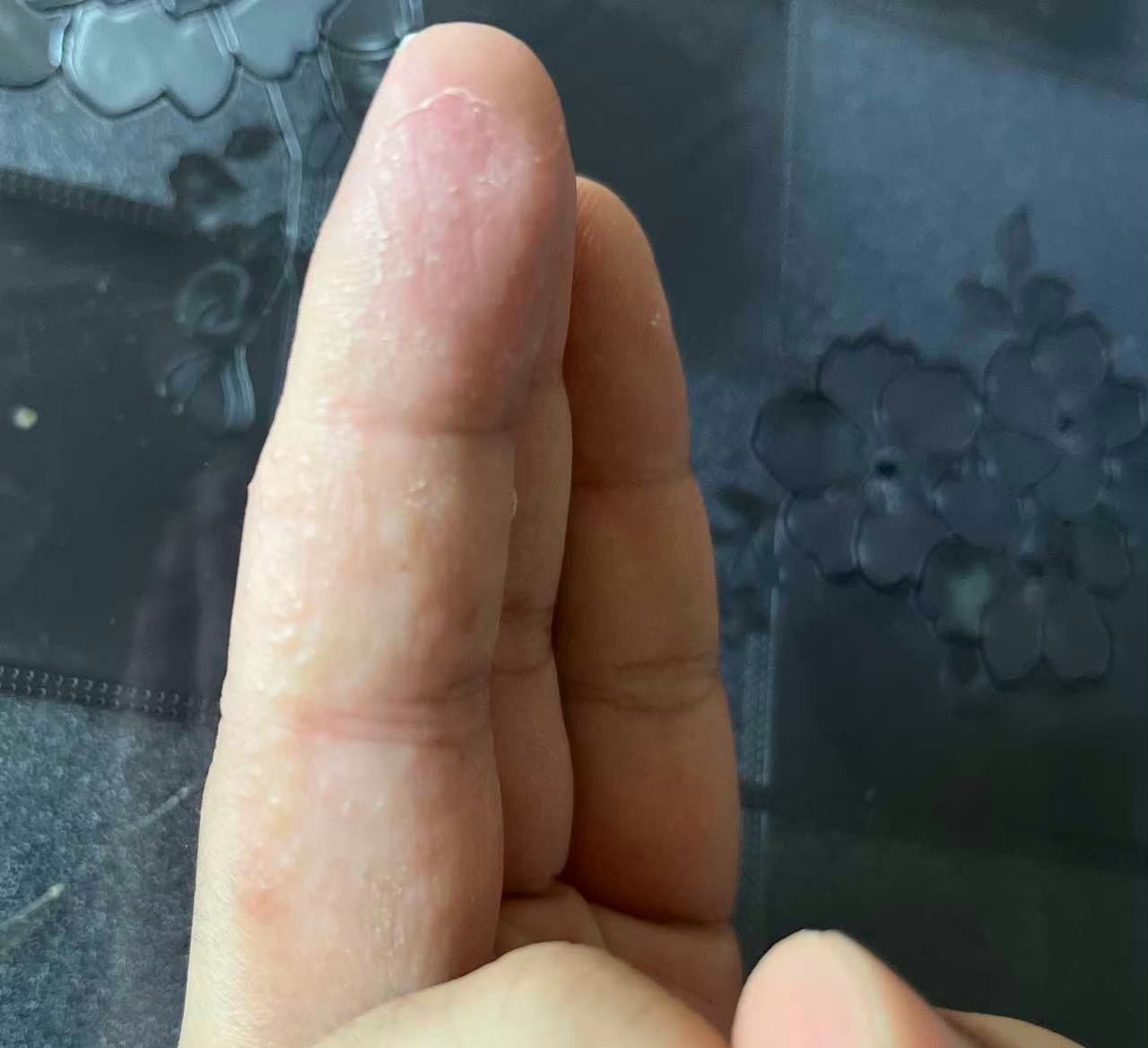 手上起水泡