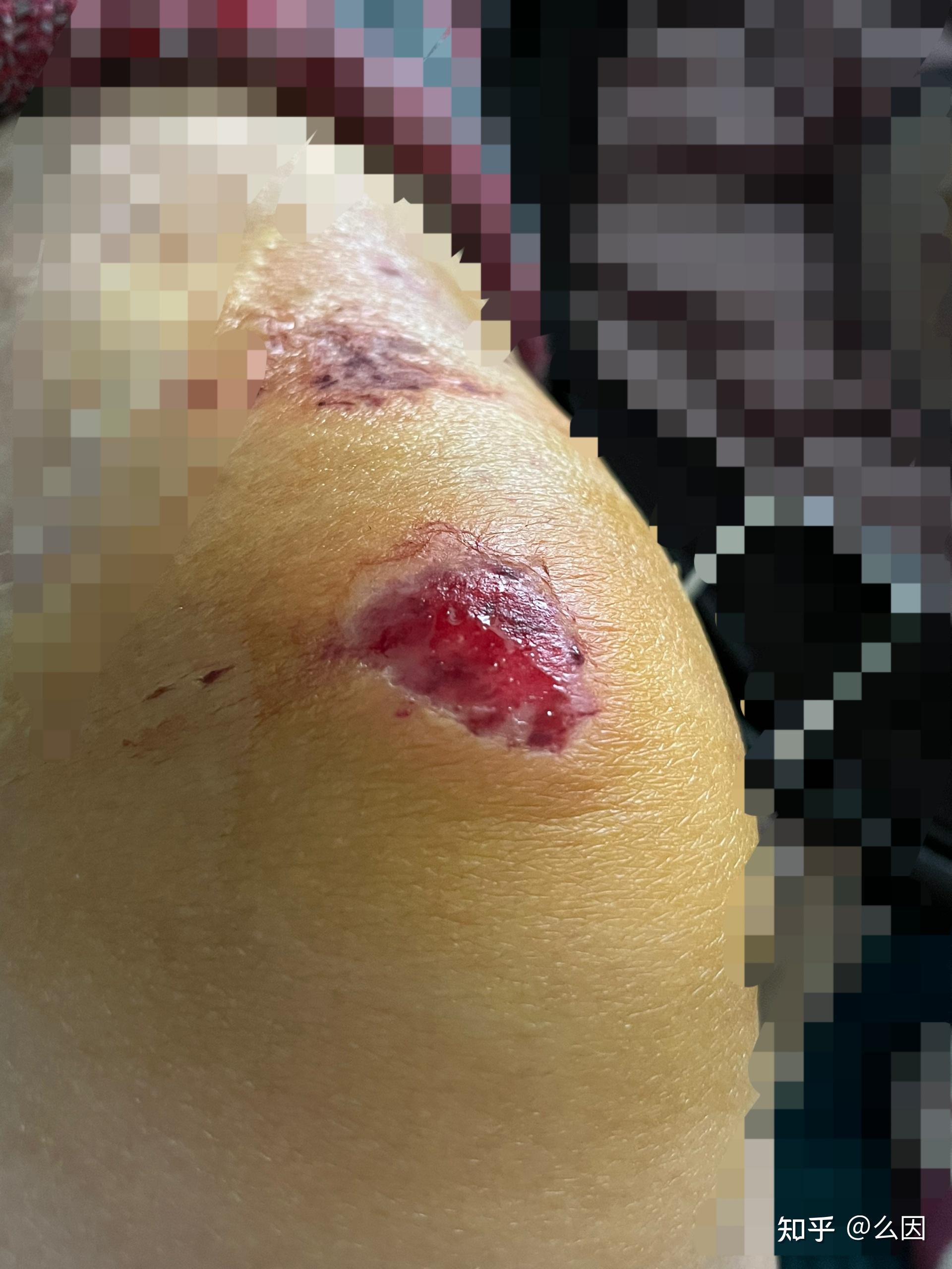 膝盖擦伤了一般要多久才能好?