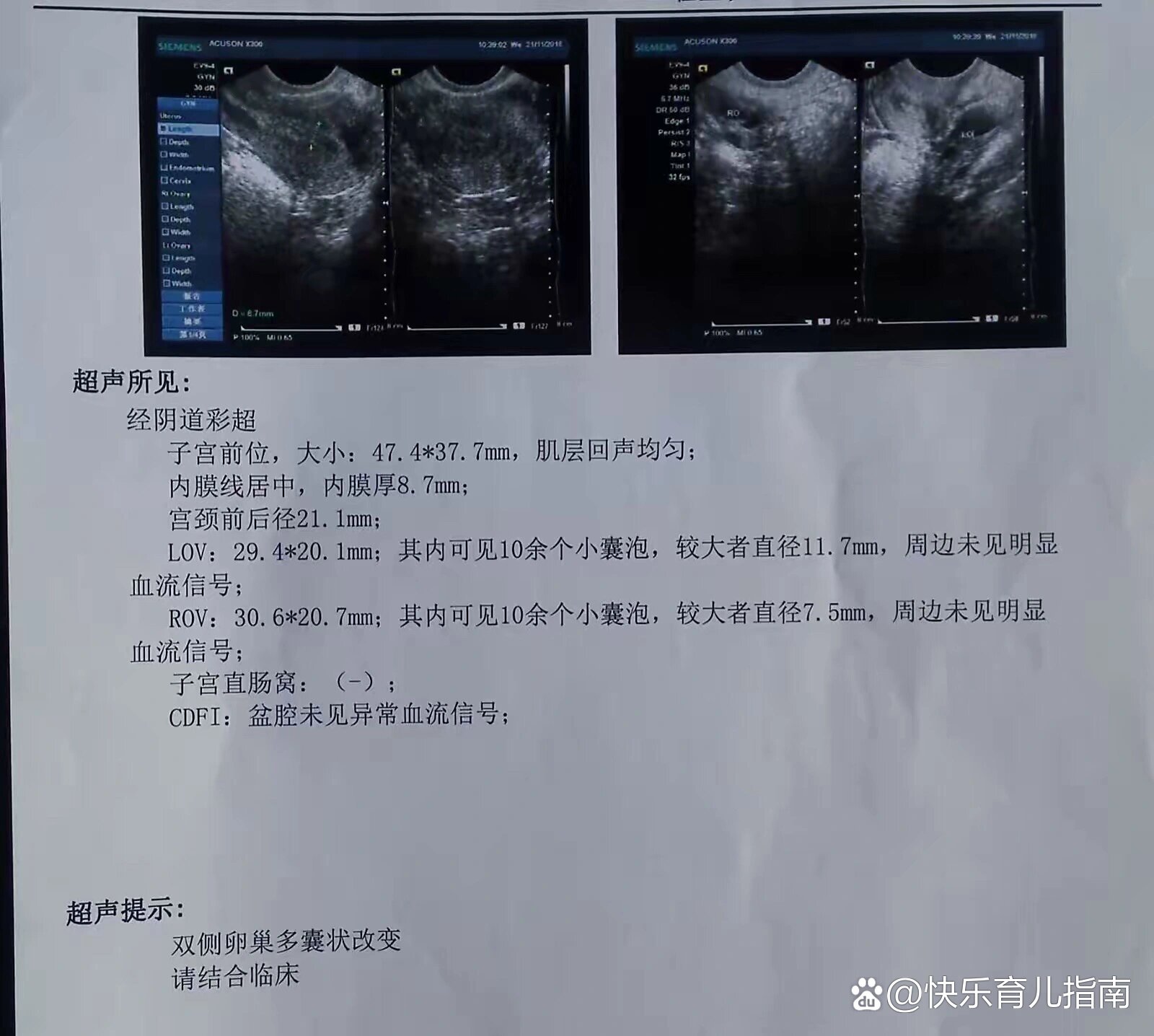 右侧卵巢多囊样改变严重吗