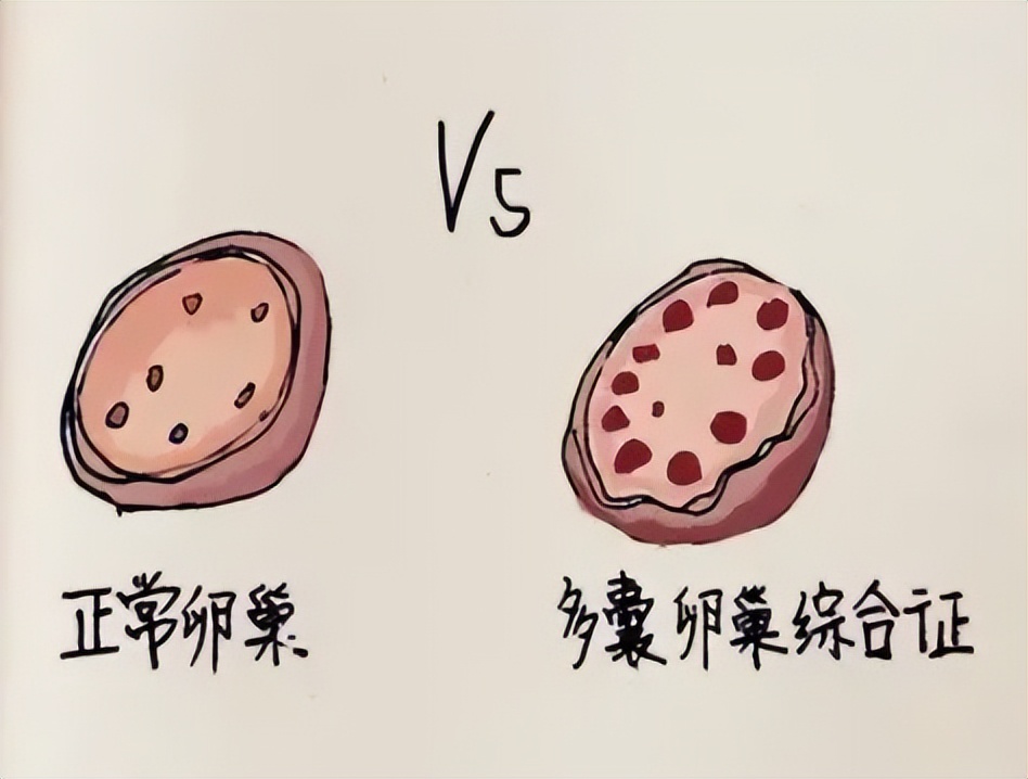 右侧卵巢多囊样改变严重吗