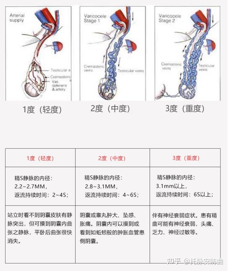 精索静脉曲张手术后多久可以恢复正常