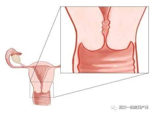 宫颈锥切术是什么?
