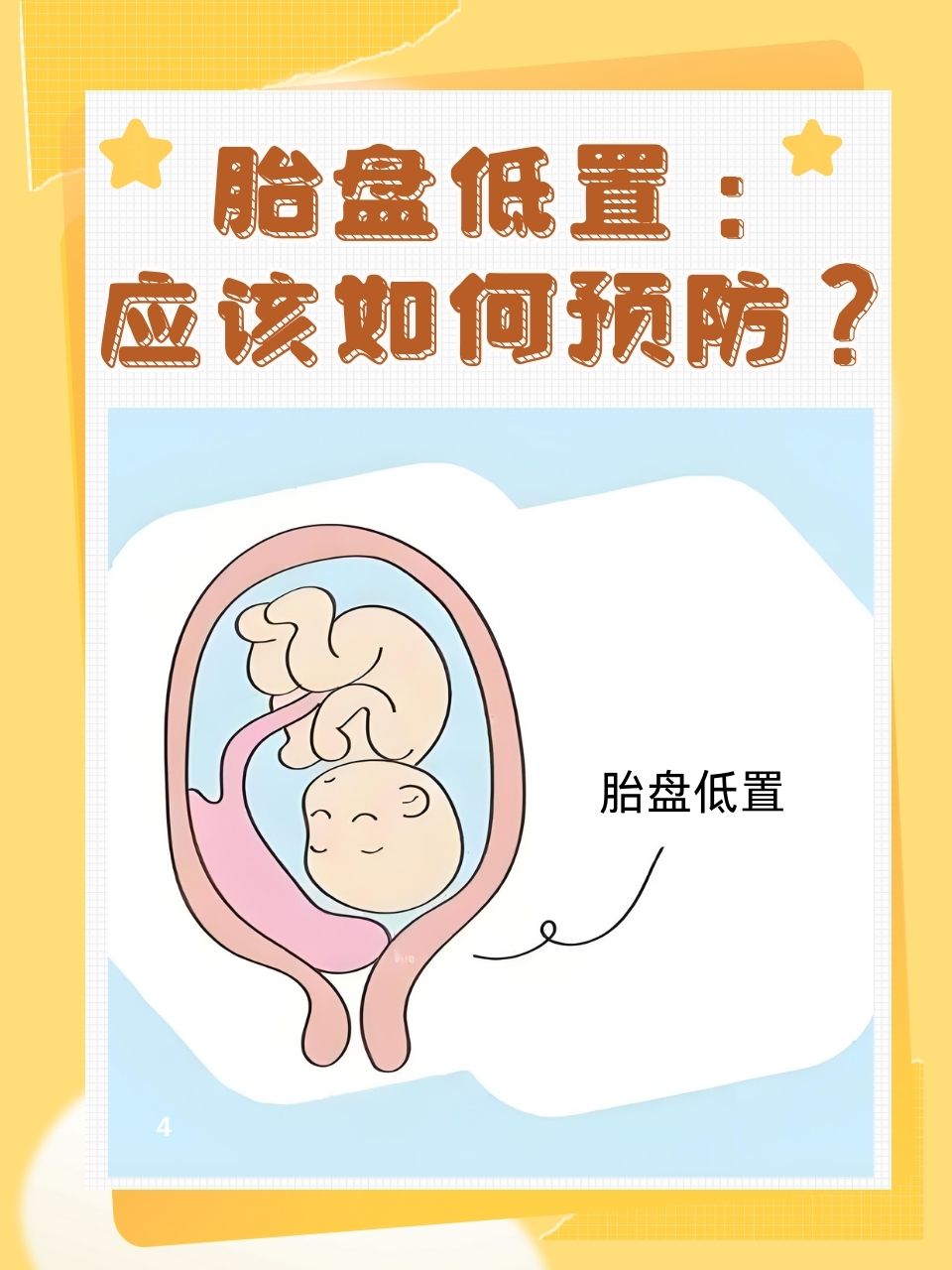 低置胎盘能顺产吗
