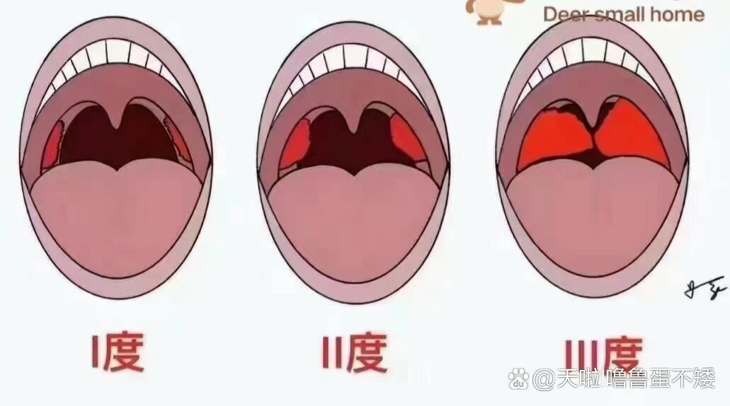 扁桃体肿大分哪几度