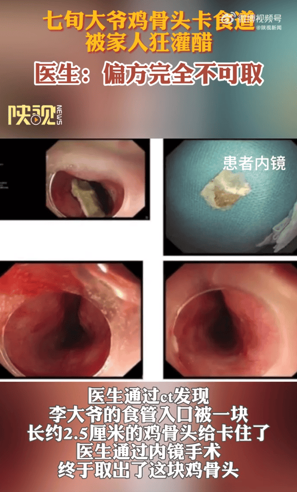 吞了鸡骨头怎么办?