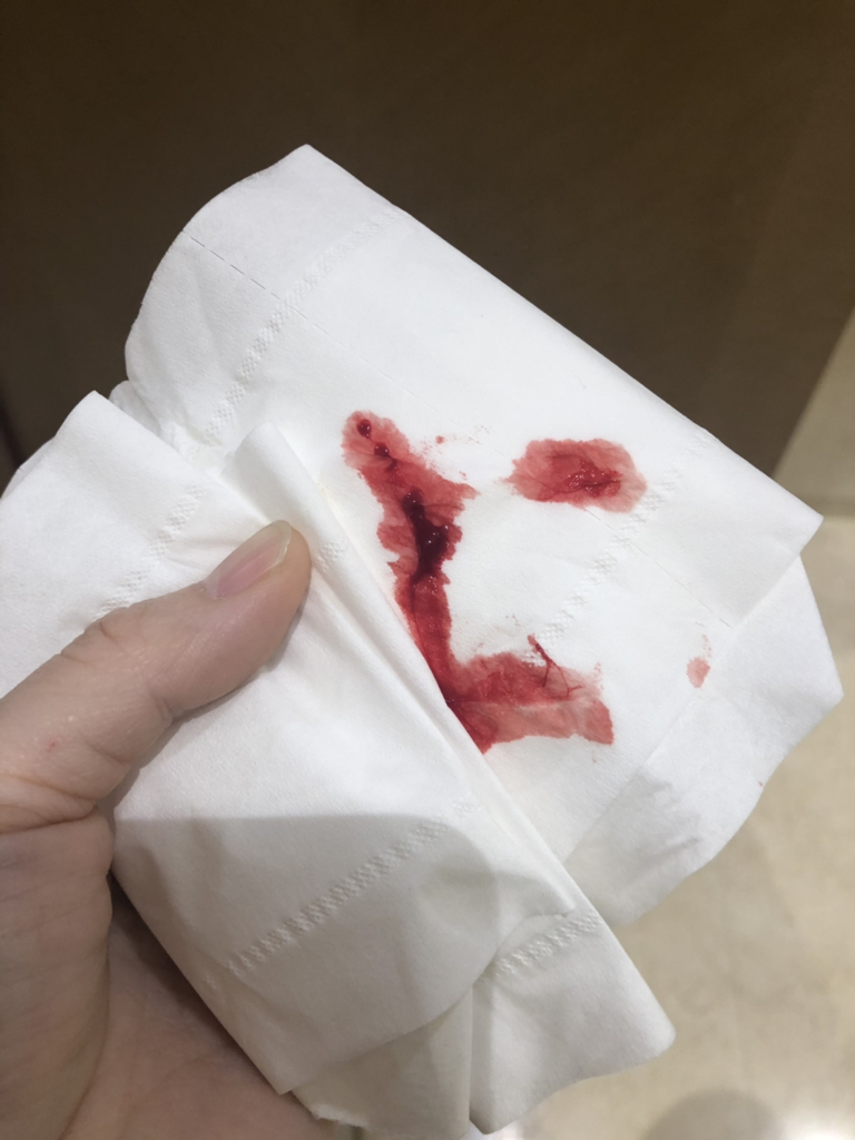大便出血,但是不痛.