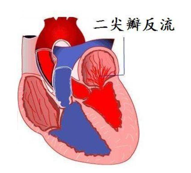 主动脉瓣反流