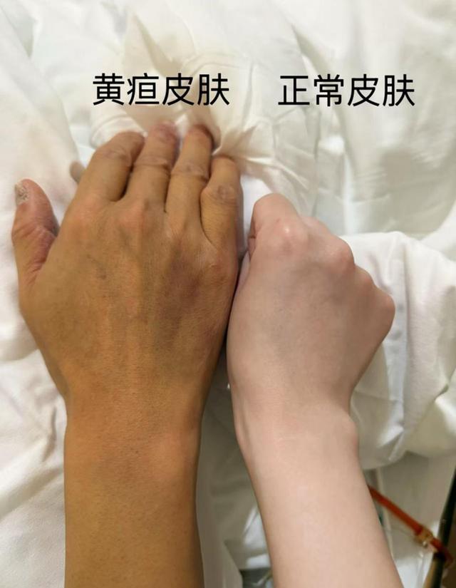 成人黄疸的临床表现是什么
