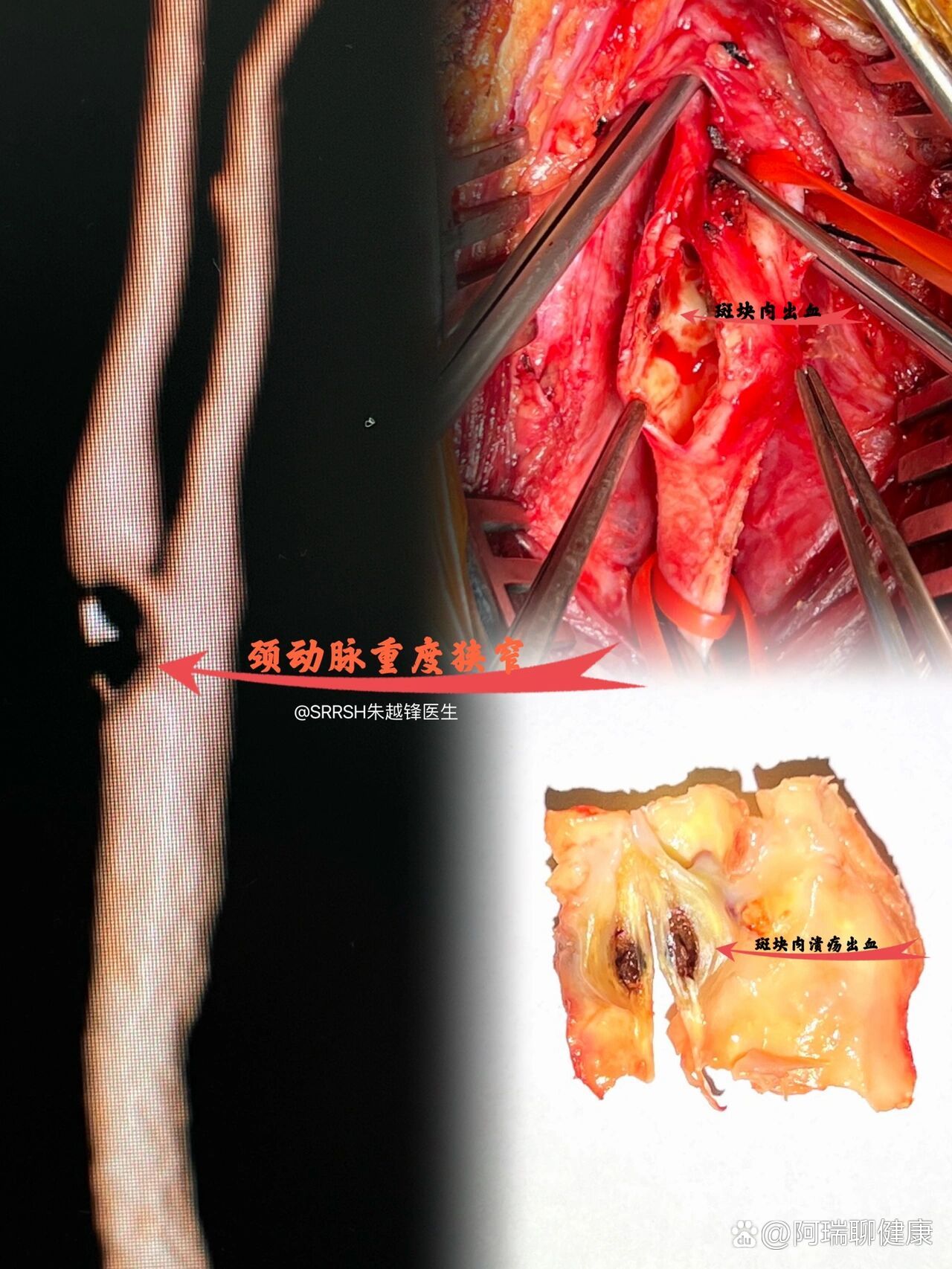颈动脉内膜切除术是什么?