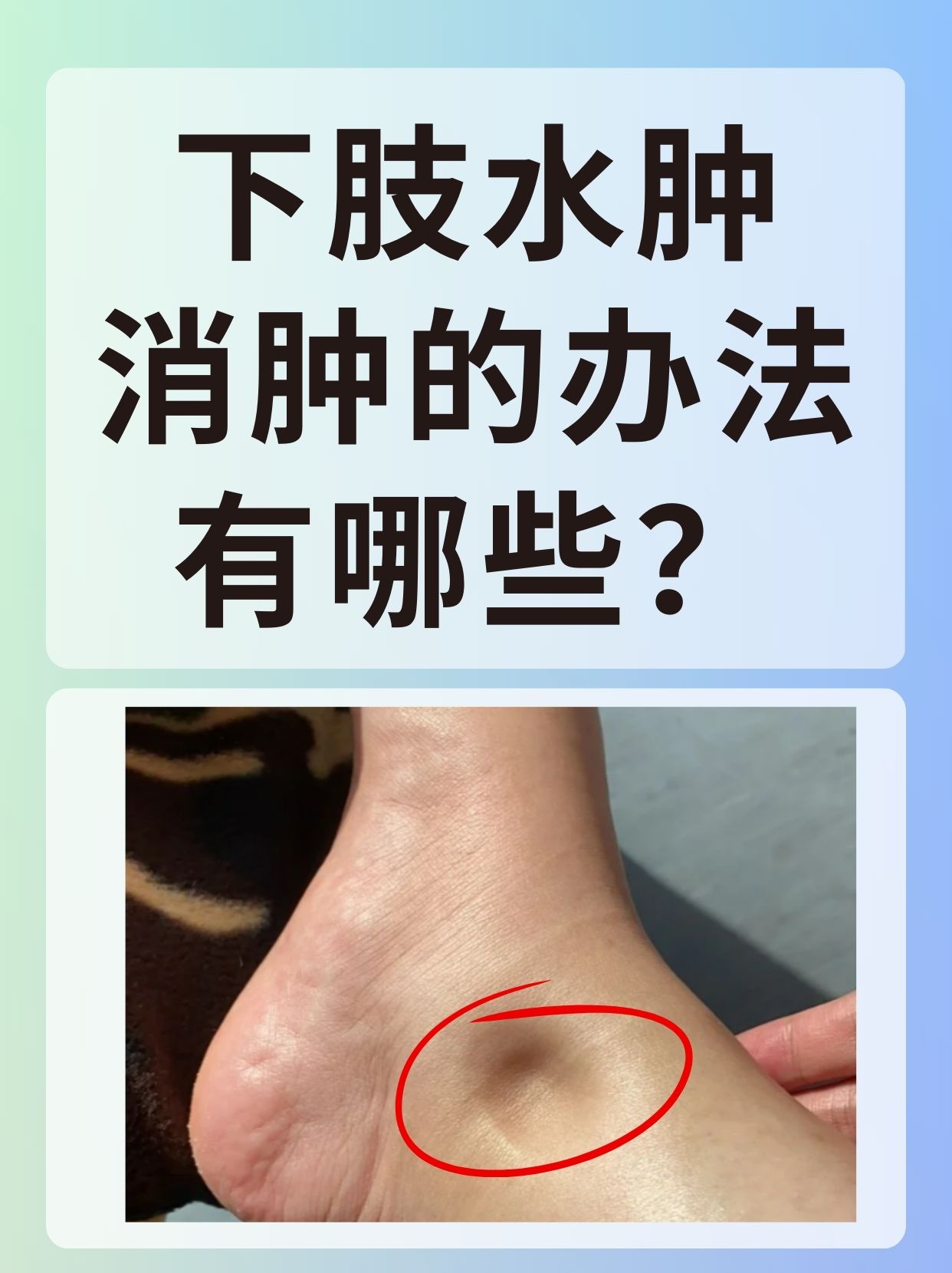 小腿浮肿一按一个坑,是怎么回事?