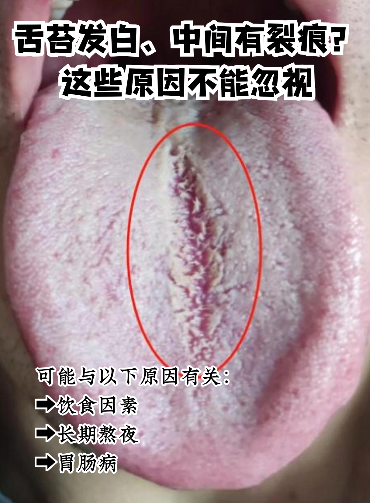 舌苔发白是怎么回事?