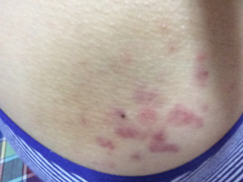 屁股上长了很多小红疙瘩怎么办?