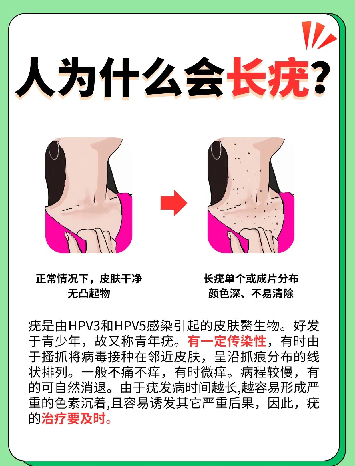 扁平疣能治愈吗?