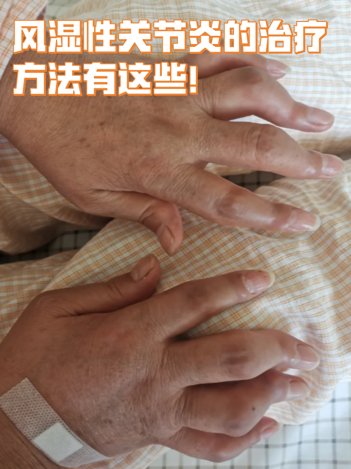 风湿病的症状早期症状