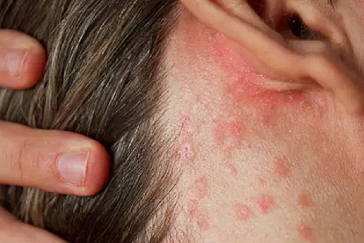 耳朵后面长了很多痘痘是怎么回事