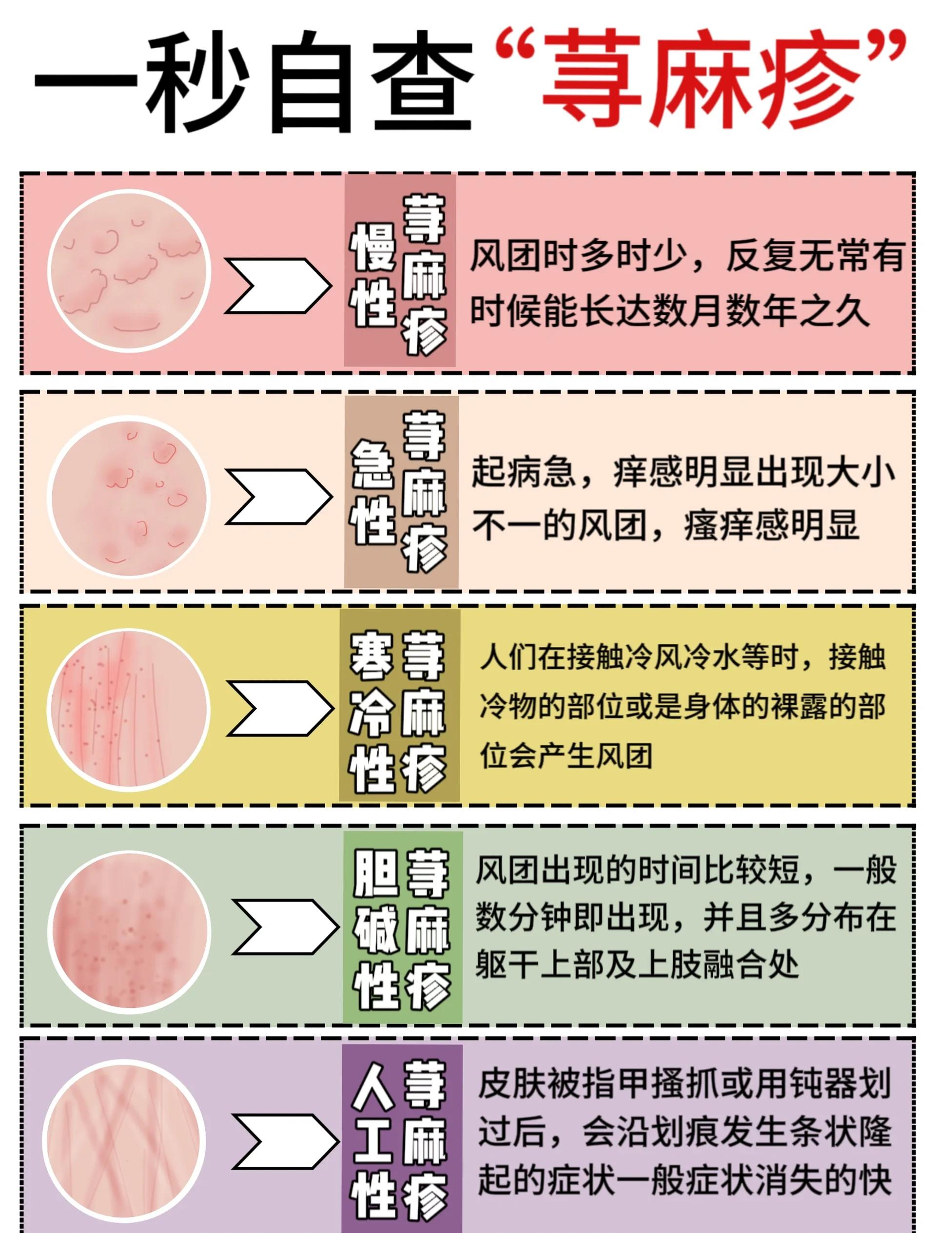 麻疹和荨麻疹的区别