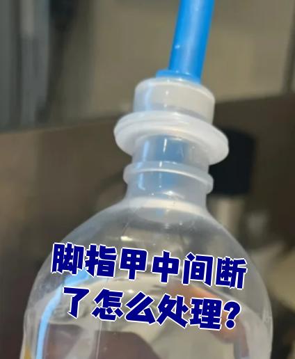 小指甲从中间断了怎么办?