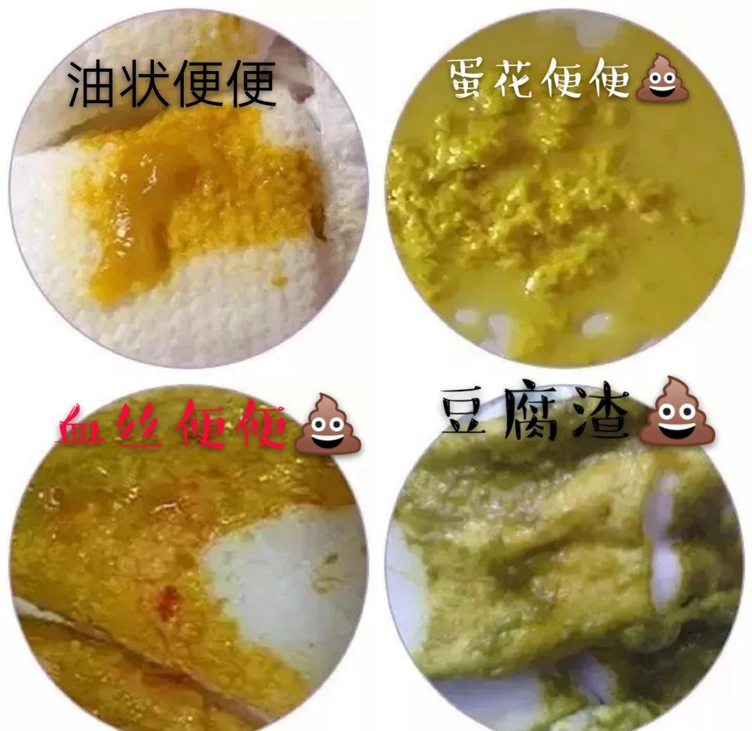 宝宝拉屎有奶瓣怎么回事