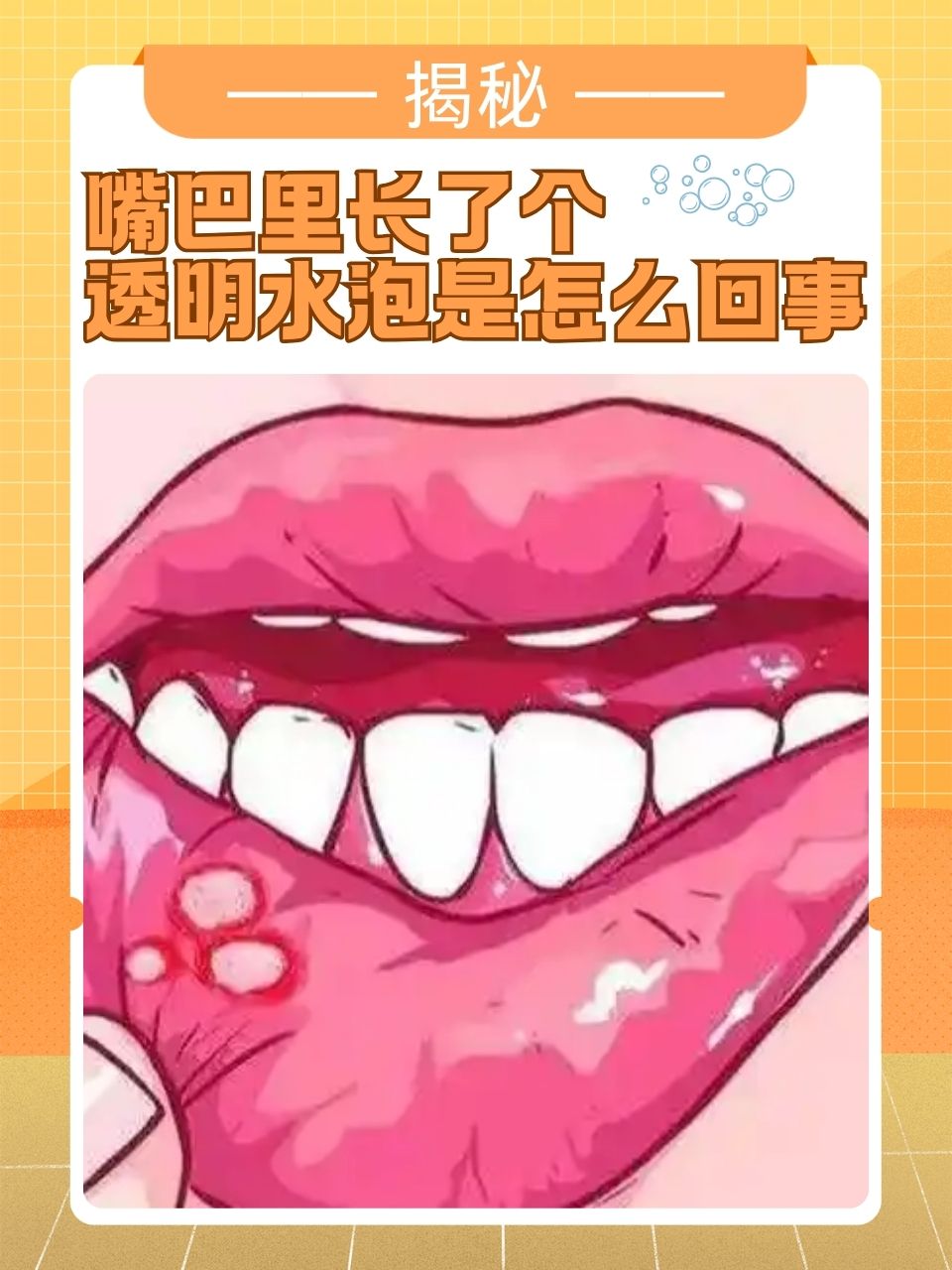 嘴巴里长了个透明的水泡