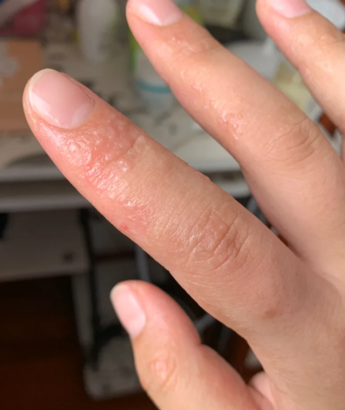 手无故好痒,没有症状